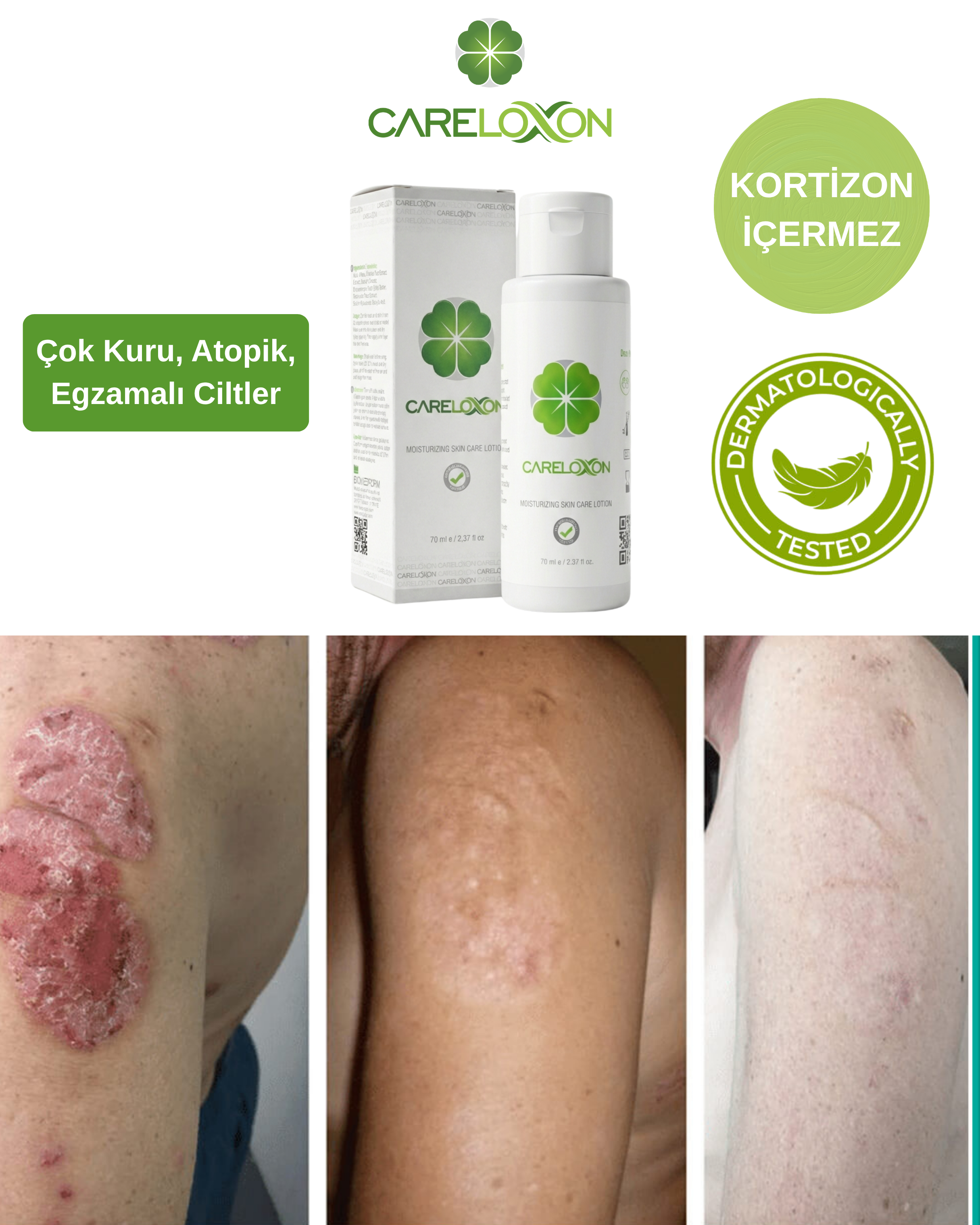 Neden Doğru Sedef ve Egzama Kremi Bulmak Bu Kadar Zor?