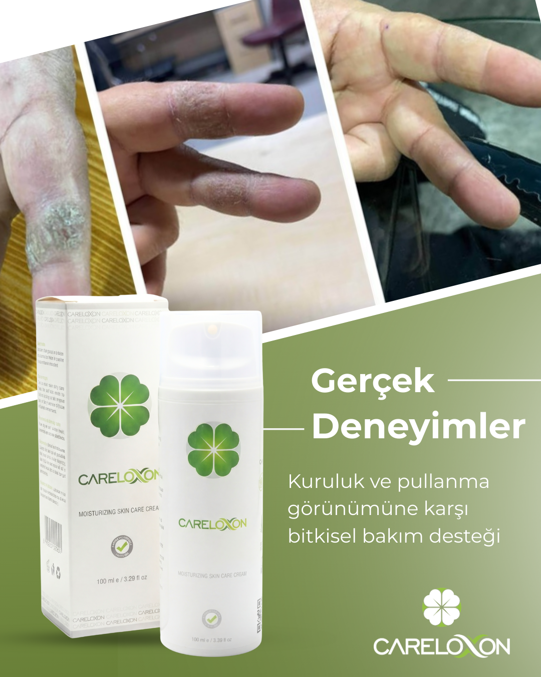 Sedefe ve Egzamaya Eğilimli Ciltler için Cilt Bakım Kremi