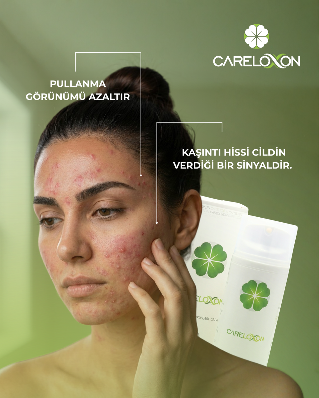 Sedefe ve Egzamaya Eğilimli Ciltler için Cilt Bakım Kremi