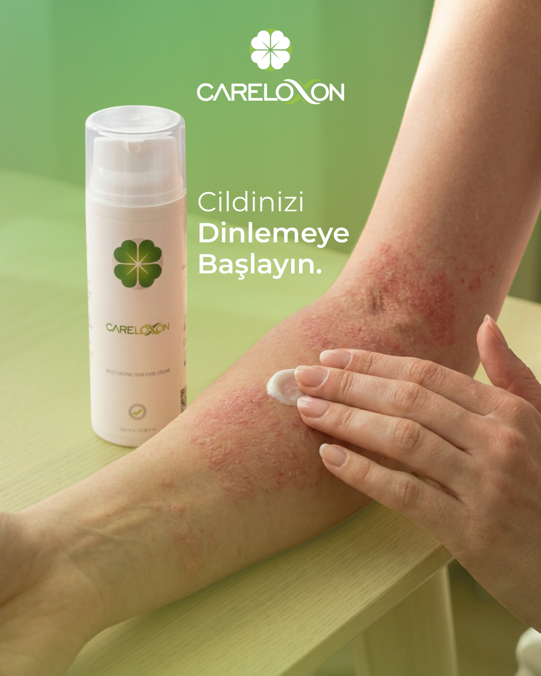 Sedefe ve Egzamaya Eğilimli Ciltler için Cilt Bakım Kremi